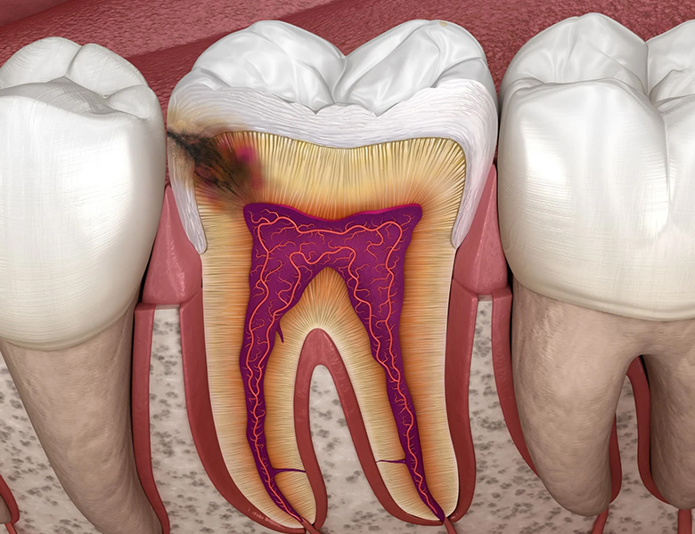 西馬込（大田区）の歯医者、なおい歯科クリニックのむし歯治療