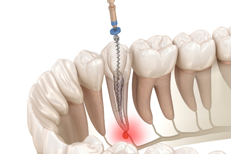 西馬込（大田区）の歯医者、なおい歯科クリニックの根管治療