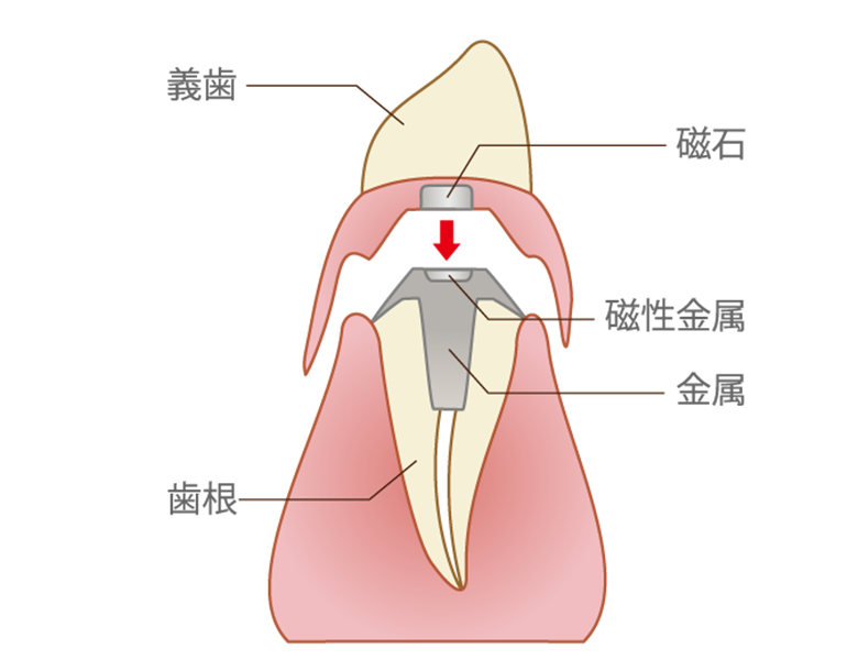 西馬込（大田区）の歯医者、なおい歯科クリニックの入れ歯治療
