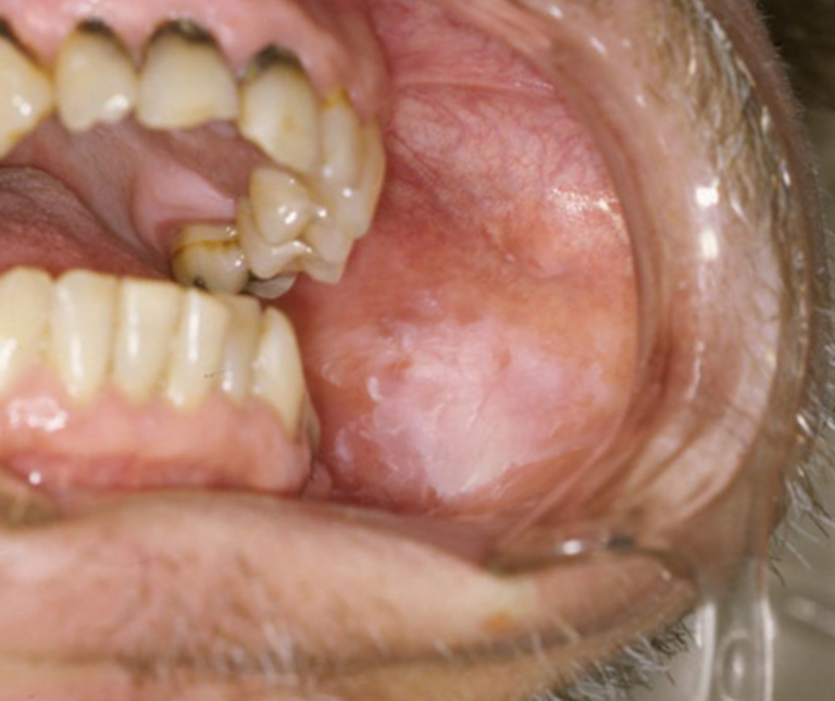 西馬込（大田区）の歯医者、なおい歯科クリニックのお口の中のデキモノ