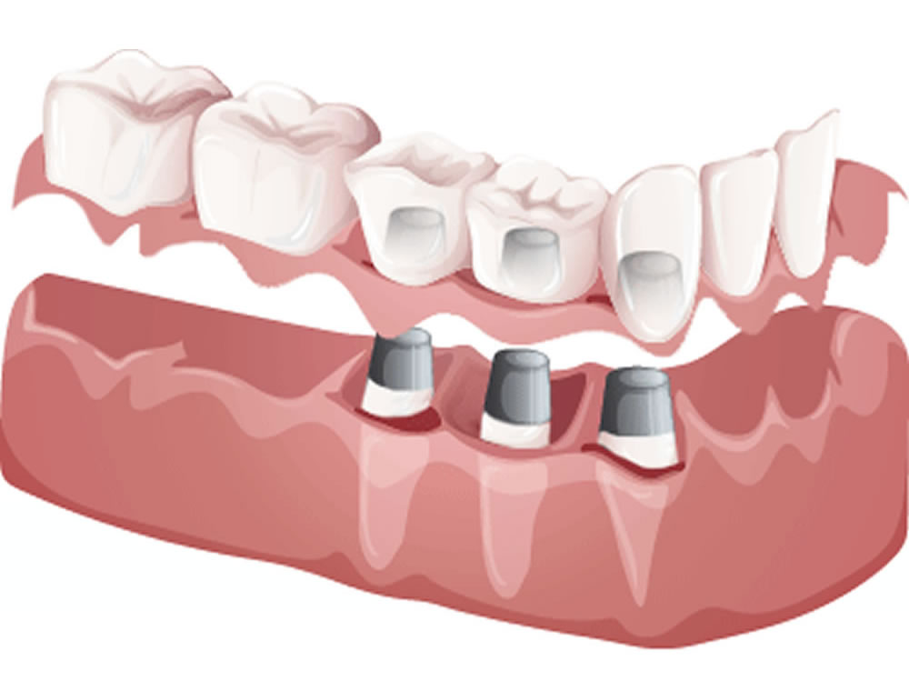 西馬込（大田区）の歯医者、なおい歯科クリニックの入れ歯治療