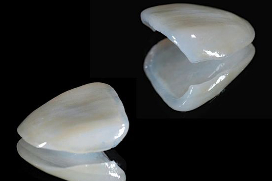 西馬込（大田区）の歯医者、なおい歯科クリニックの審美歯科治療