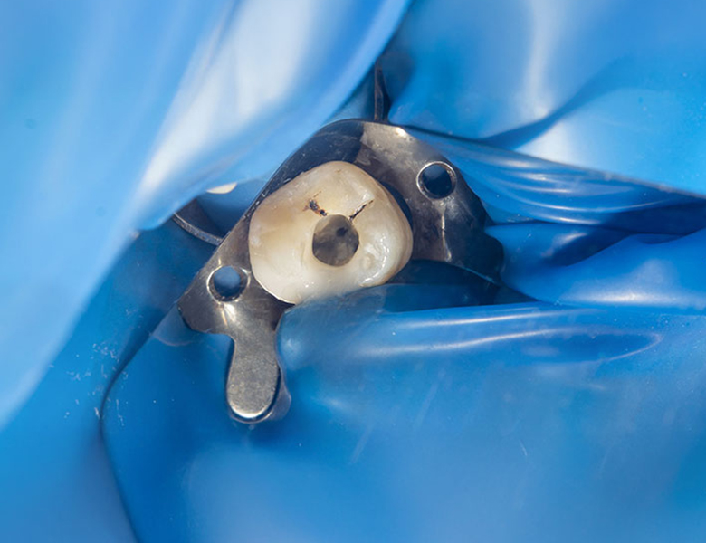 西馬込（大田区）の歯医者、なおい歯科クリニックのマイクロスコープ精密治療