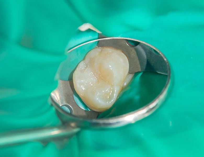 西馬込（大田区）の歯医者、なおい歯科クリニックの根管治療