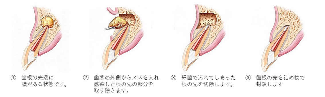 西馬込（大田区）の歯医者、なおい歯科クリニックの根管治療