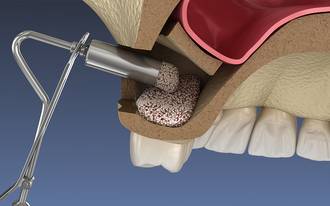 西馬込（大田区）の歯医者、なおい歯科クリニックのインプラント治療