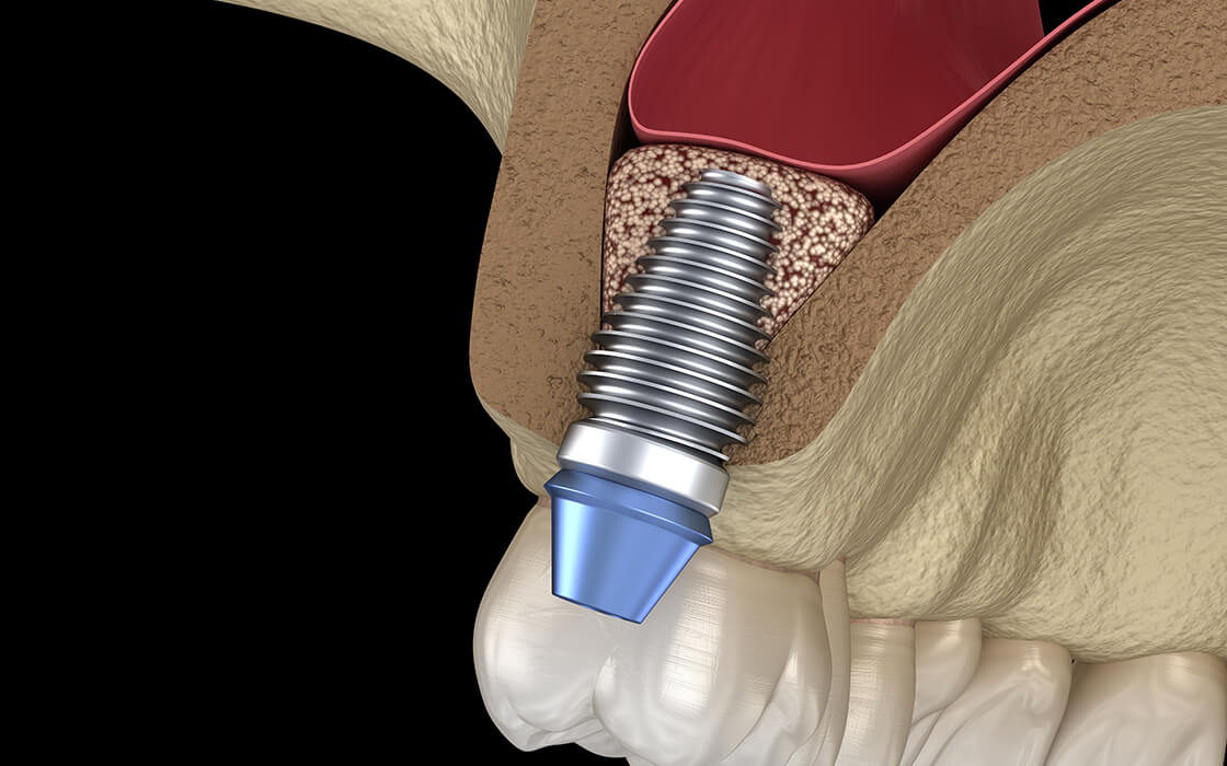 西馬込（大田区）の歯医者、なおい歯科クリニックのインプラント治療